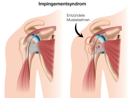 Impigement Syndrom