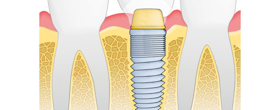Illustration Dentalimplantate
