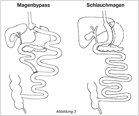 Zeichnung metabolische Chirurgie Magenbypass oder Schaluchmagen