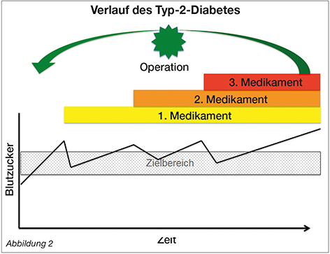 Tabelle Metabolische ChirurgieVerlauf des Typ-2-Diabetes